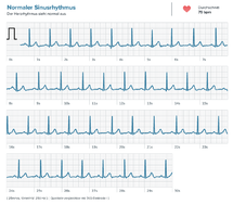 EKG.png